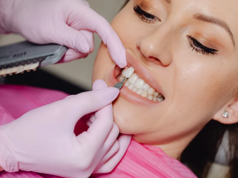 veneers match clove family dental