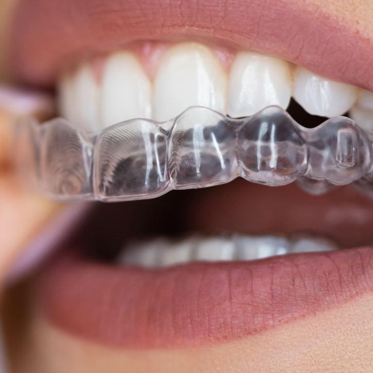 clear aligners